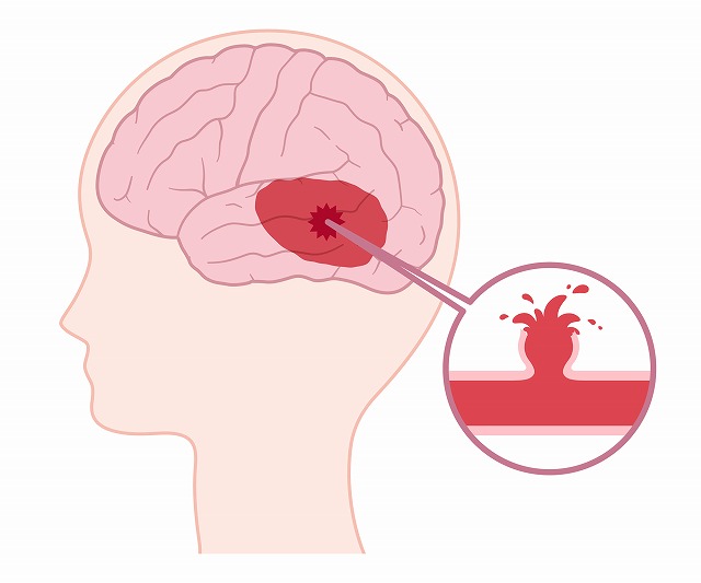 くも膜下出血の原因